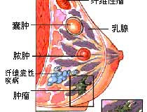 卵巢囊肿的常见症状